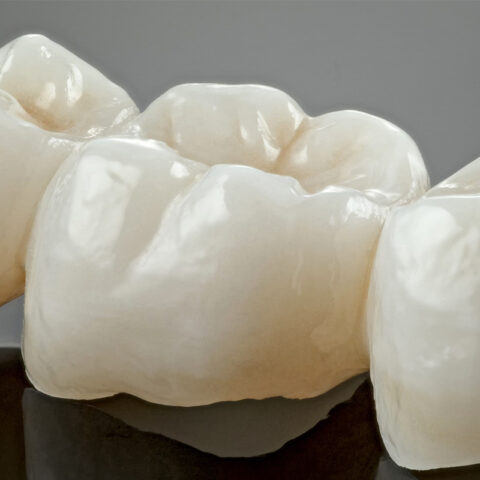 Corona dentale in ceramica integrale ad alta resa estetica